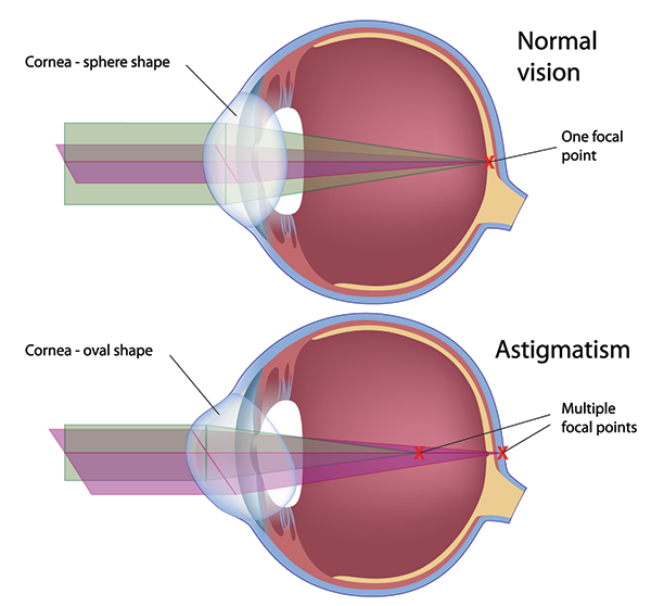 Astigmatism in Fort Wayne