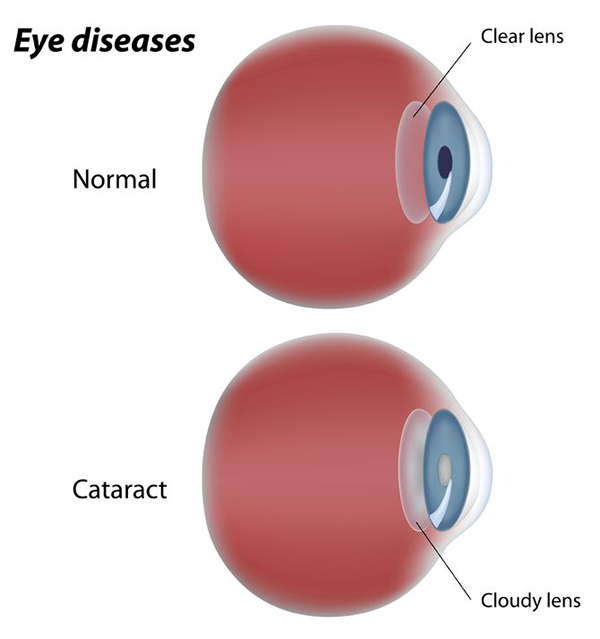 Cataract Treatment in Fort Wayne