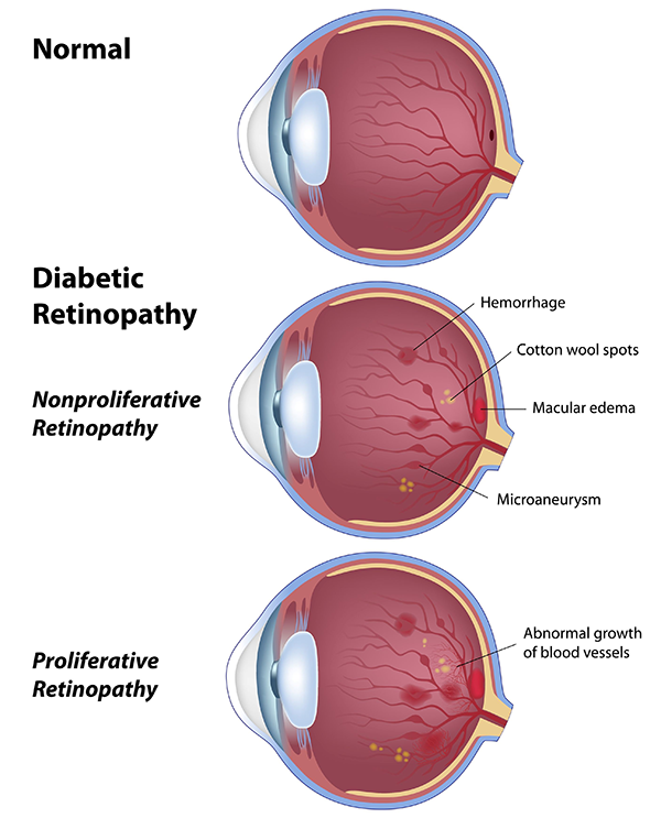 Diabetic Eye Care in Fort Wayne