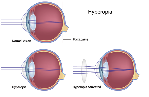 Correct Farsightedness in Fort Wayne