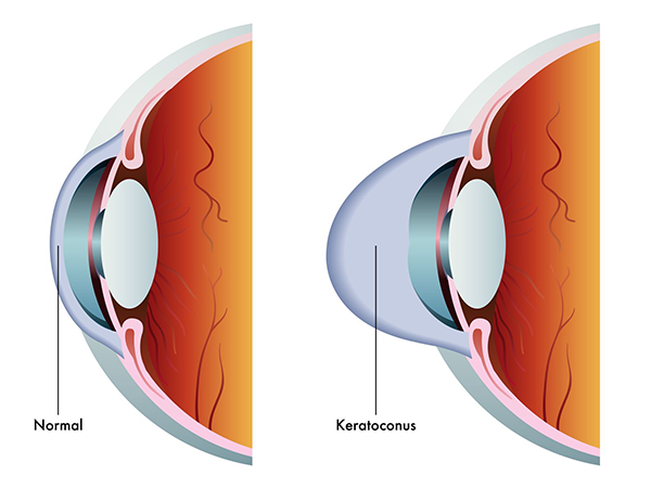 Keratoconus in Fort Wayne