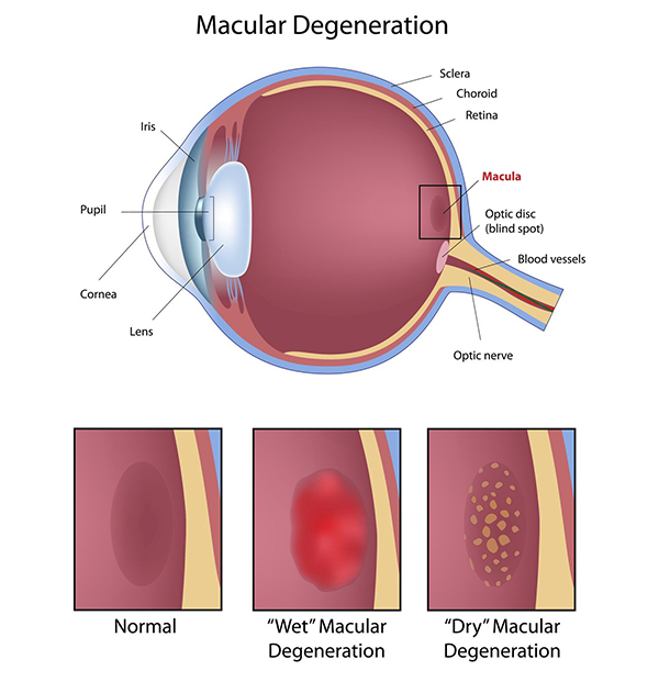 Dry Macular Degeneration Fort Wayne