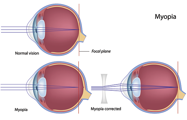 Optometrist in Fort Wayne