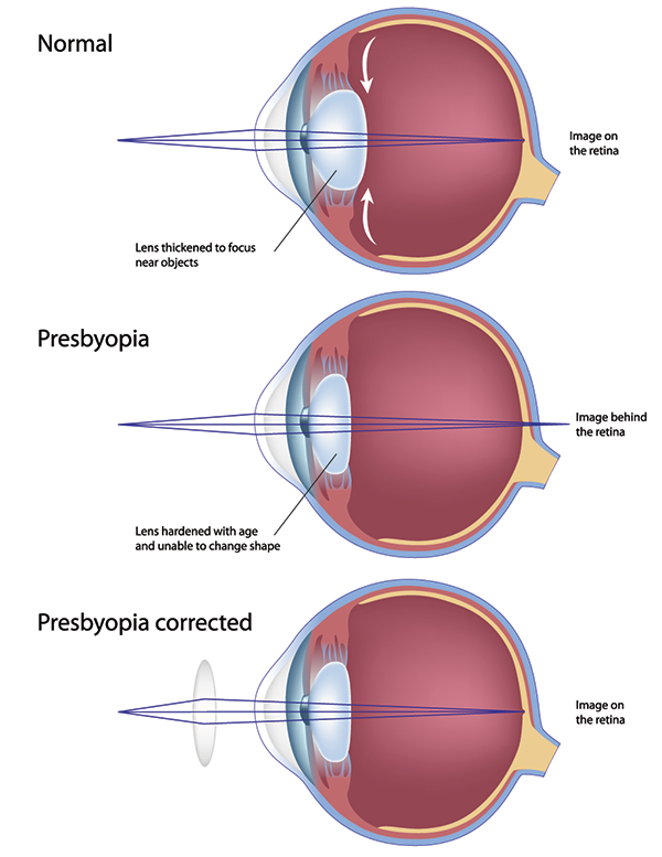 Eye Doctor in Fort Wayne